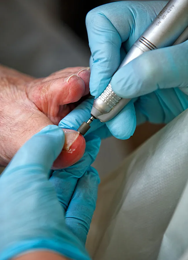 Podologikum Mauritz - Behandlung Schritt 3