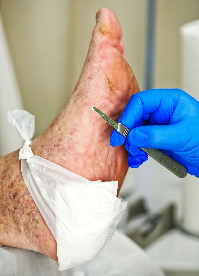 Podologikum Mauritz - Behandlung Schritt 2