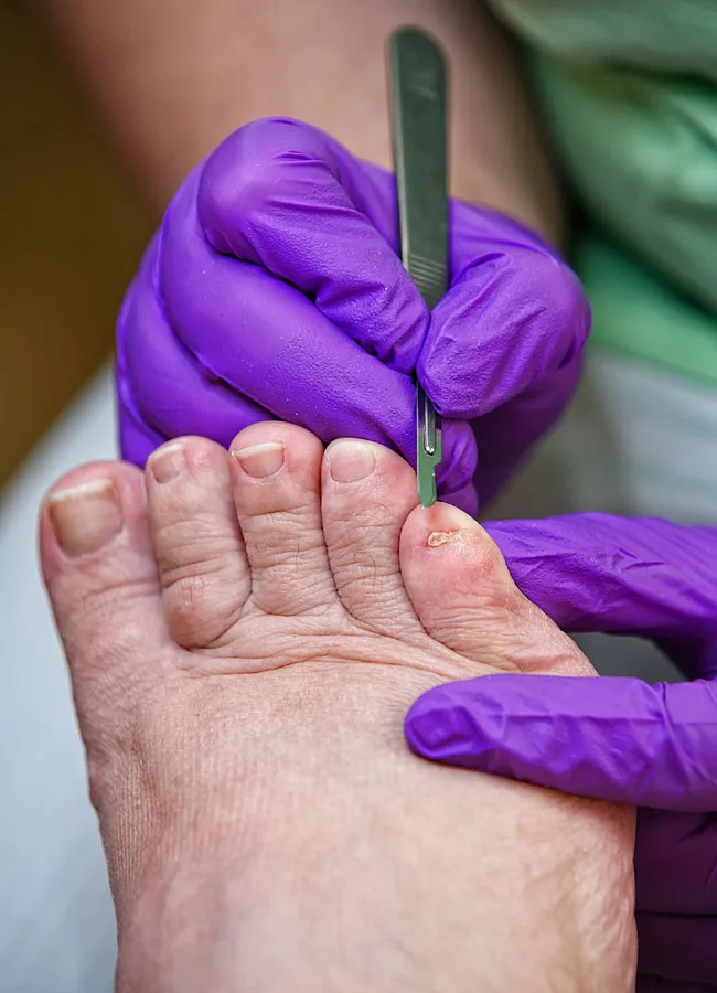 Podologikum Mauritz - Behandlung Schritt 2