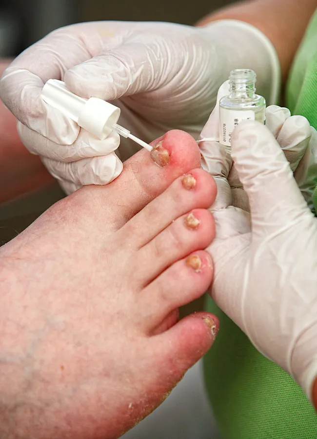 Podologikum Mauritz - Behandlung Schritt 3